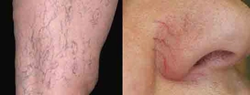 Kılcal Damar Lazer Tedavisi