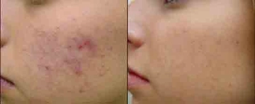 Lazer ile Sivilce İzi Tedavisi