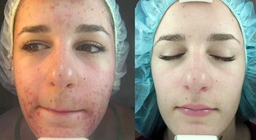 Lazer Tedavisi Fiyatları