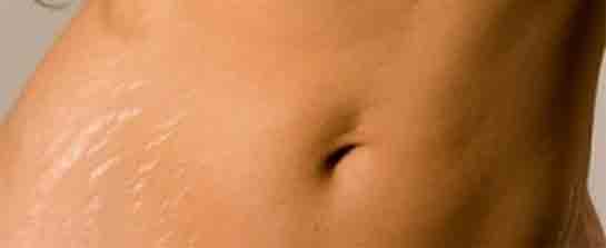 Çatlak Tedavisi Lazer