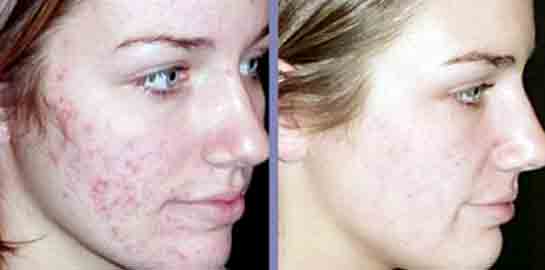 Cilt Lazer Tedavisi Belirtileri ve Tedavisi