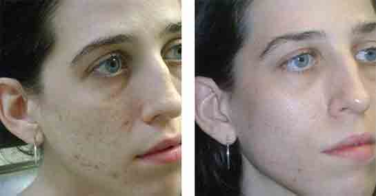 Fraksiyonel Lazer Tedavisi