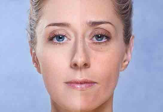 Göz Altı Torbaları Lazer Tedavisi