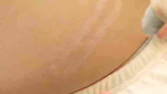 Lazer Çatlak Tedavisi