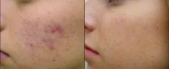 Lazer ile Sivilce İzi Tedavisi