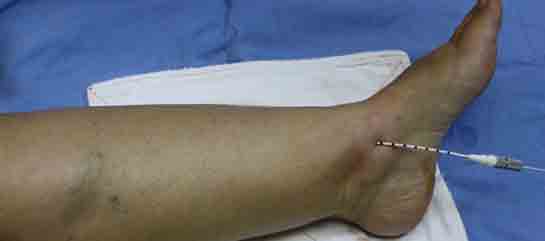 Lazerle Varis Tedavisi